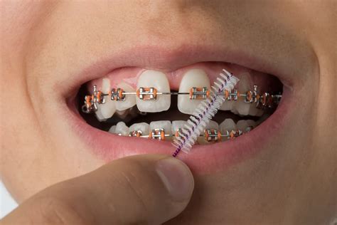 cuidarse los dientes con brackets metalicos|limpiar dientes con brackets.